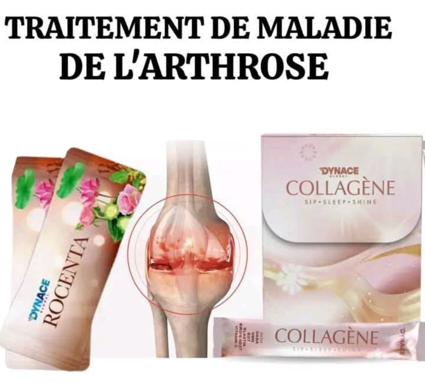 Arthrose